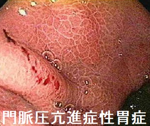 門脈圧亢進症性胃症
