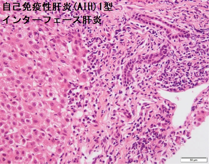 自己免疫性肝炎(AIH)1型、インターフェース肝炎 組織像 自己免疫性肝炎(AIH)1型、インターフェース肝炎 組織像