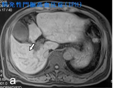 特発性門脈高血圧症(IPH)患者におけるMRI T1WI 画像 特発性門脈高血圧症(IPH)患者におけるMRI T1WI 画像