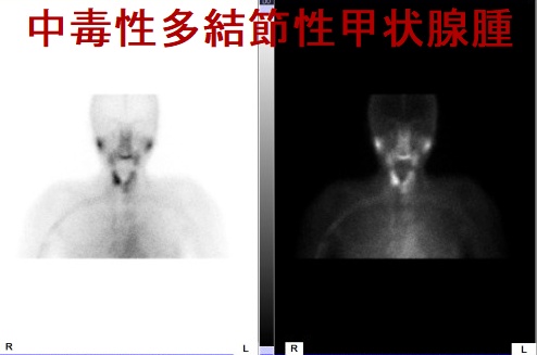 中毒性多結節性甲状腺腫(TMNG)Tcシンチグラム1 中毒性多結節性甲状腺腫(TMNG)Tcシンチグラム3