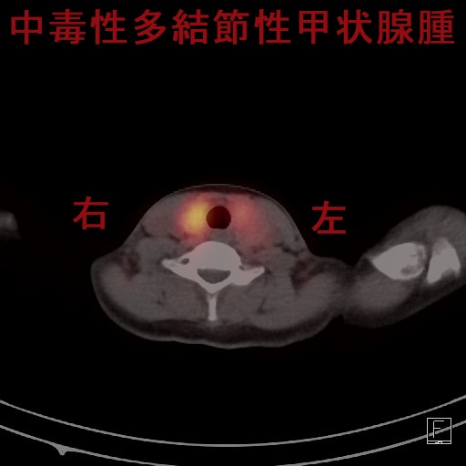 中毒性多結節性甲状腺腫(TMNG) 99mTCシンチグラフィー(水平断) 中毒性多結節性甲状腺腫(TMNG) 99mTCシンチグラフィー(水平断)