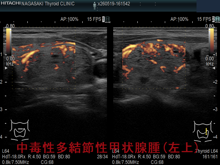 中毒性多結節性甲状腺腫(TMNG) 超音波(エコー)画像(左上)ドプラーモード 中毒性多結節性甲状腺腫(TMNG) 超音波(エコー)画像(左上)ドプラーモード