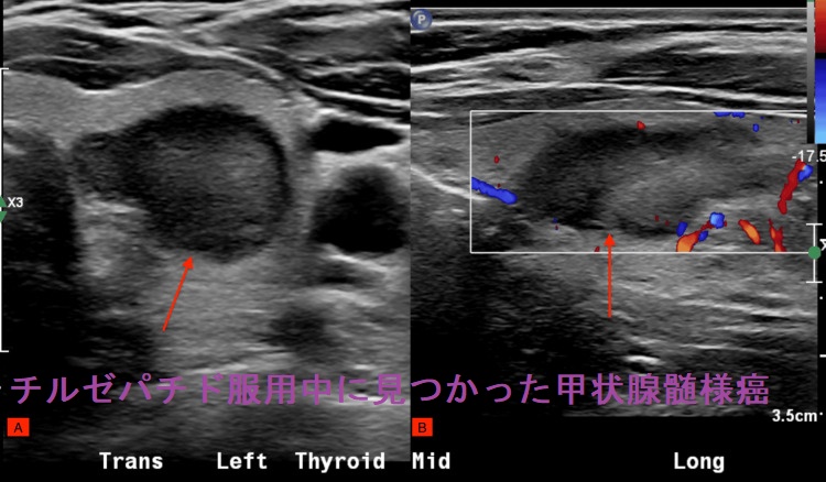チルゼパチド服用中に見つかった甲状腺髄様癌 超音波(エコー)画像 チルゼパチド服用中に見つかった甲状腺髄様癌 超音波(エコー)画像