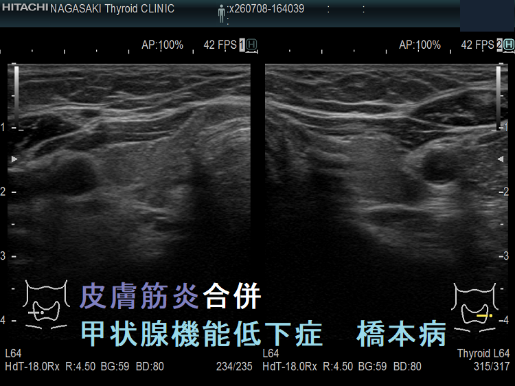 皮膚筋炎合併 甲状腺機能低下症 橋本病 皮膚筋炎合併 甲状腺機能低下症 橋本病
