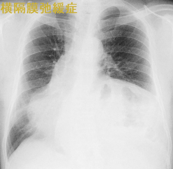 横隔膜弛緩症 胸部エックス線写真 正面像 横隔膜弛緩症 胸部エックス線写真 正面像