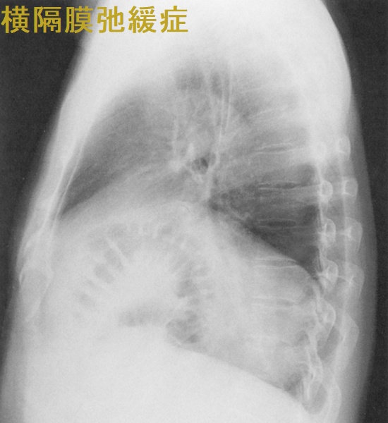 横隔膜弛緩症 胸部エックス線写真 側面像 横隔膜弛緩症 胸部エックス線写真 側面像