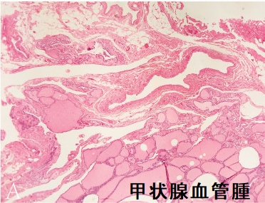 甲状腺血管腫 組織像