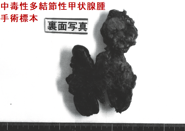 中毒性多結節性甲状腺腫(TMNG) 手術標本(裏) 中毒性多結節性甲状腺腫(TMNG) 手術標本(裏)