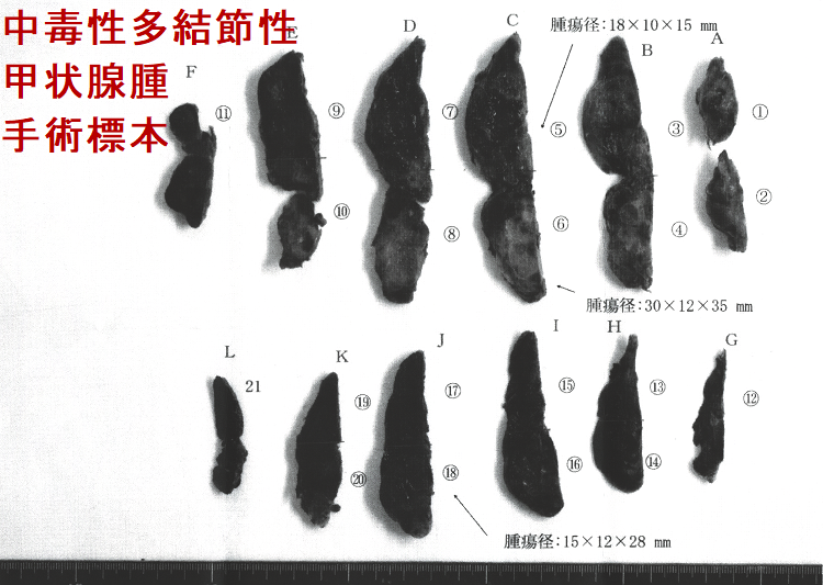 中毒性多結節性甲状腺腫(TMNG) 手術標本(割面) 中毒性多結節性甲状腺腫(TMNG) 手術標本(割面)