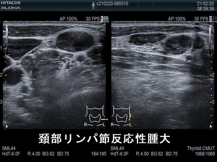 頚部リンパ節反応性腫大 超音波(エコー)画像