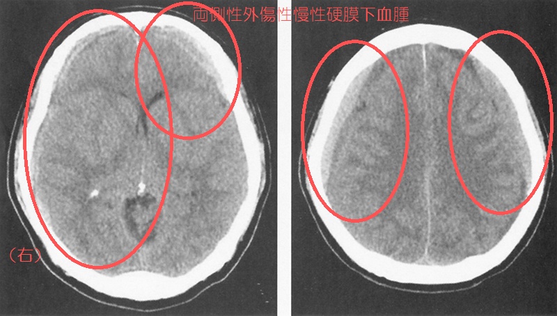 両側性外傷性慢性硬膜下血腫 両側性外傷性慢性硬膜下血腫