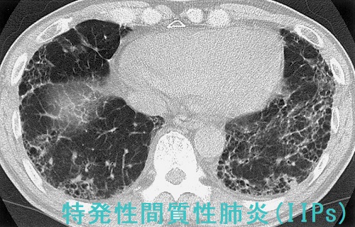 特発性間質性肺炎 CT