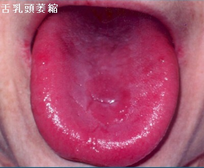 舌乳頭萎縮