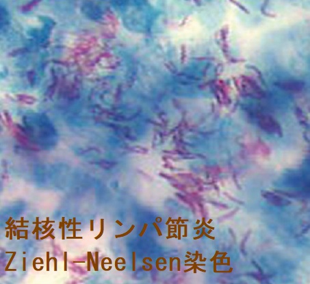 結核性リンパ節炎 Ziehl-Neelsen染色