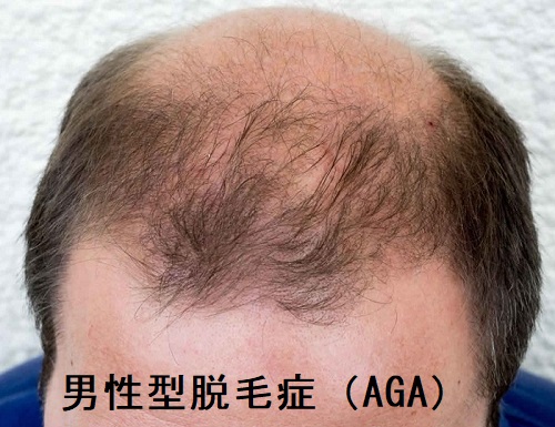 男性型脱毛症（AGA）
