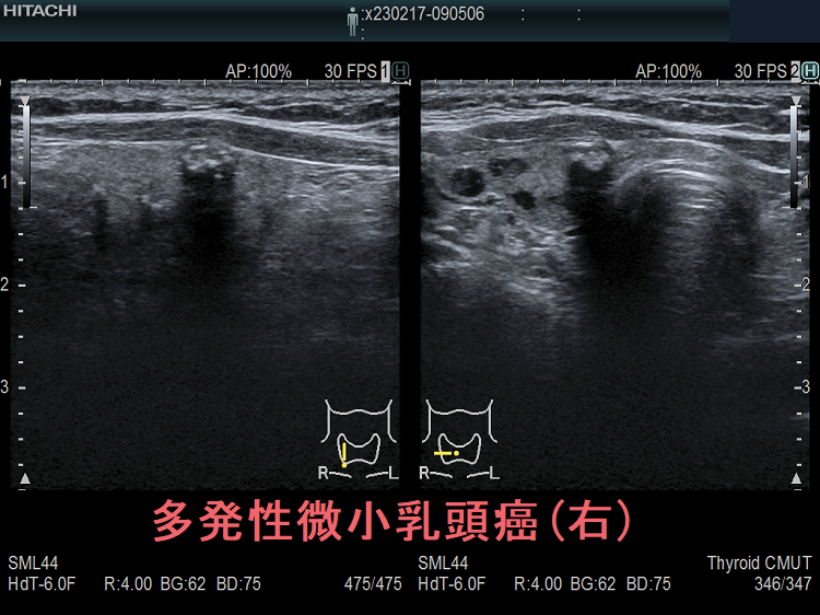 両葉多発性微小乳頭癌(右葉)  超音波(エコー)画像