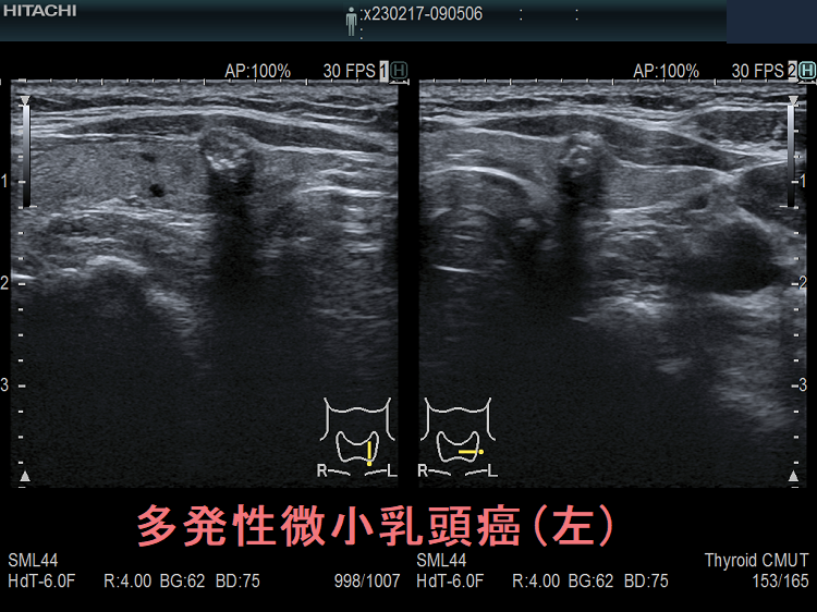 両葉多発性微小乳頭癌(左葉)  超音波(エコー)画像
