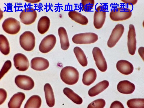 遺伝性球状赤血球症（通常型）楕円形赤血球
