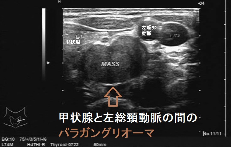 ‎甲状腺と左総頸動脈の間のパラガングリオーマ 超音波(エコー)画像