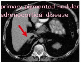 原発性色素性結節性副腎疾患(primary pigmented nodular adrenocortical disease:PPNAD)