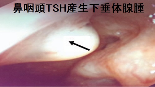 鼻咽頭TSH産生下垂体腺腫