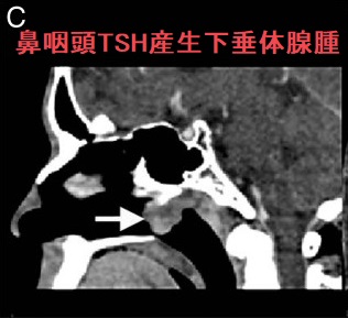 鼻咽頭TSH産生下垂体腺腫 CT画像