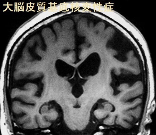 大脳皮質基底核変性症 MRI T1 強調画像