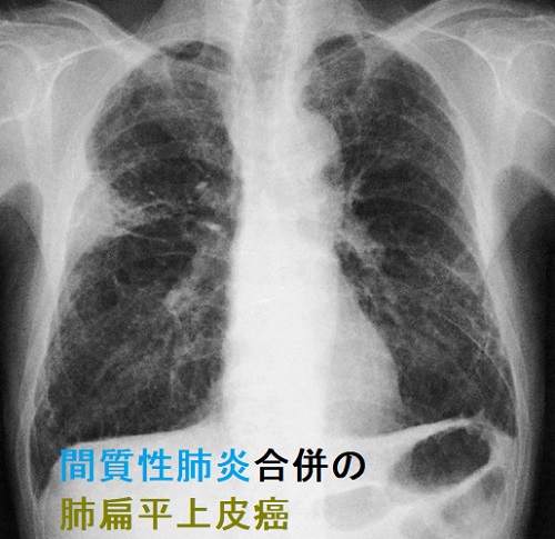 間質性肺炎に肺扁平上皮癌を合併 胸部X線