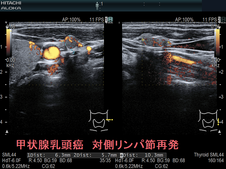 甲状腺乳頭癌 対側（切除していない側）リンパ節再発 超音波(エコー)画像 ドプラーモード