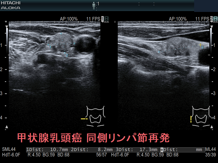 甲状腺乳頭癌の同側（切除した側）のリンパ節再発 超音波(エコー)画像