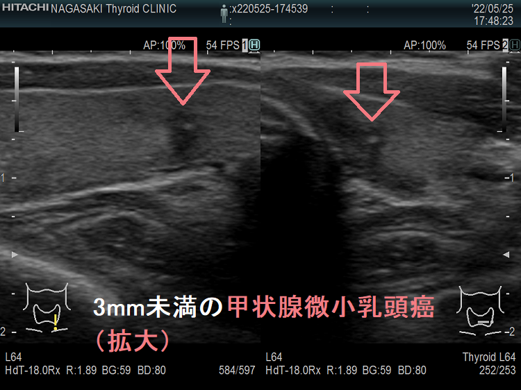 3mm未満の甲状腺微小乳頭癌(拡大) 超音波(エコー)画像