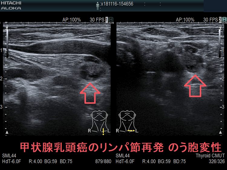 甲状腺乳頭癌の左鎖骨上窩 リンパ節再発 のう胞変性 超音波(エコー)画像