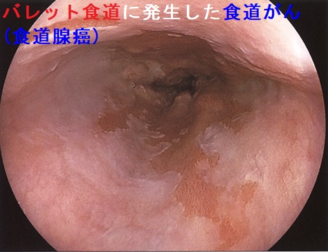 バレット食道に発生した食道がん(食道腺癌) バレット食道に発生した食道がん(食道腺癌)