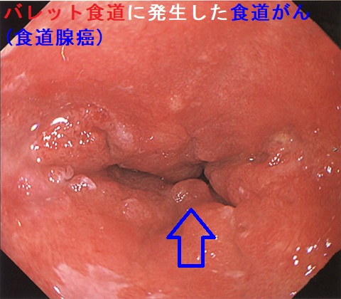 バレット食道に発生した食道がん(食道腺癌) 近接像 バレット食道に発生した食道がん(食道腺癌) 近接像