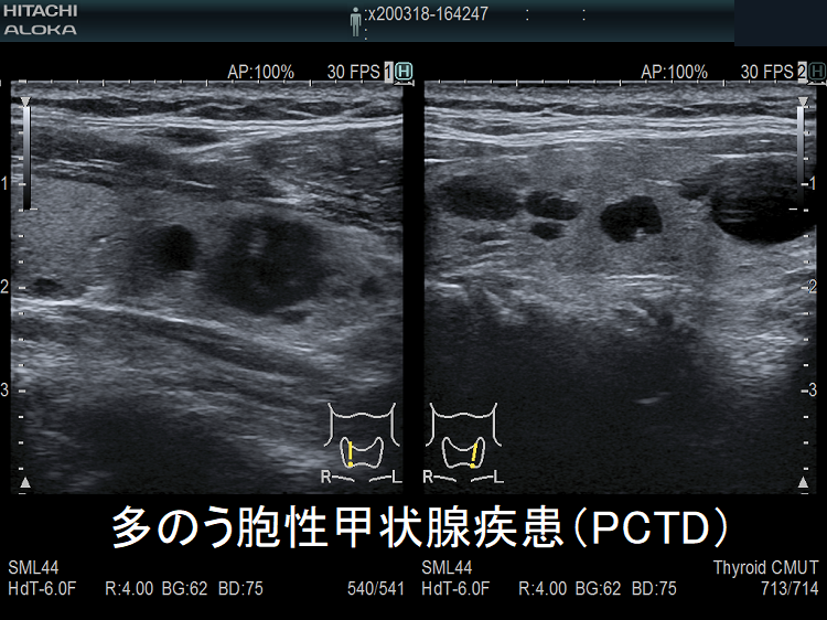 多のう胞性甲状腺疾患（PCTD） 超音波(エコー)画像