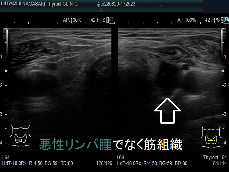 甲状腺悪性リンパ腫でなく頚筋組織 超音波(エコー)画像
