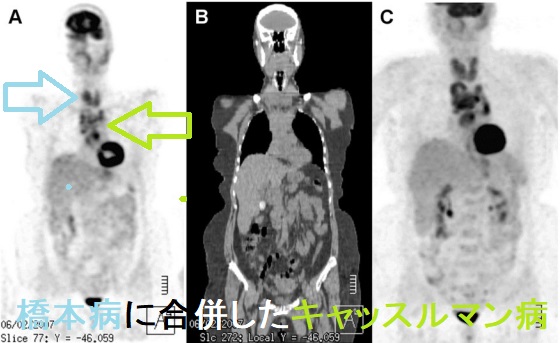 橋本病に合併したキャッスルマン病 PET-CT画像