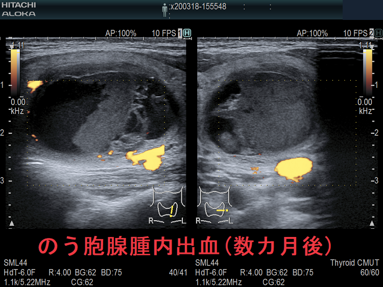 のう胞腺腫内出血(数カ月後) 超音波（エコー）画像 ドプラーモード