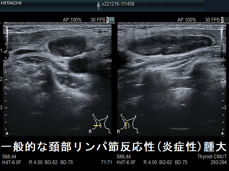 一般的な頚部リンパ節反応性(炎症性)腫大 超音波(エコー)画像