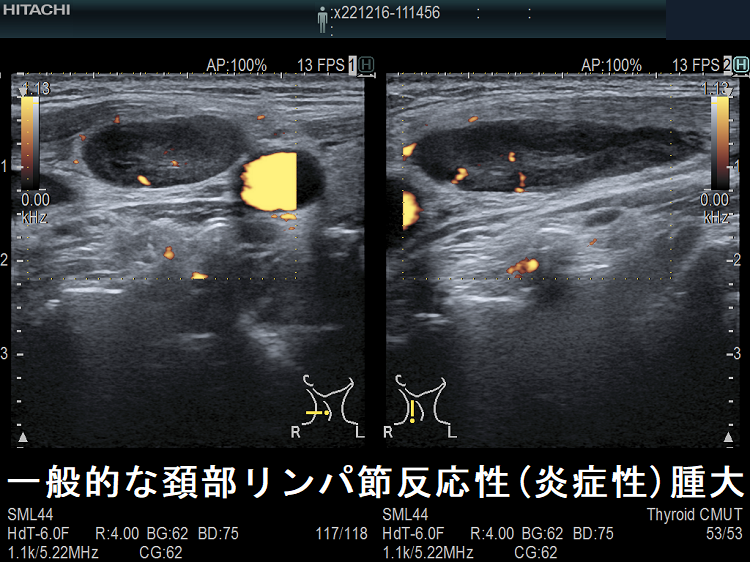 一般的な頚部リンパ節反応性(炎症性)腫大 超音波(エコー)画像ドプラーモード