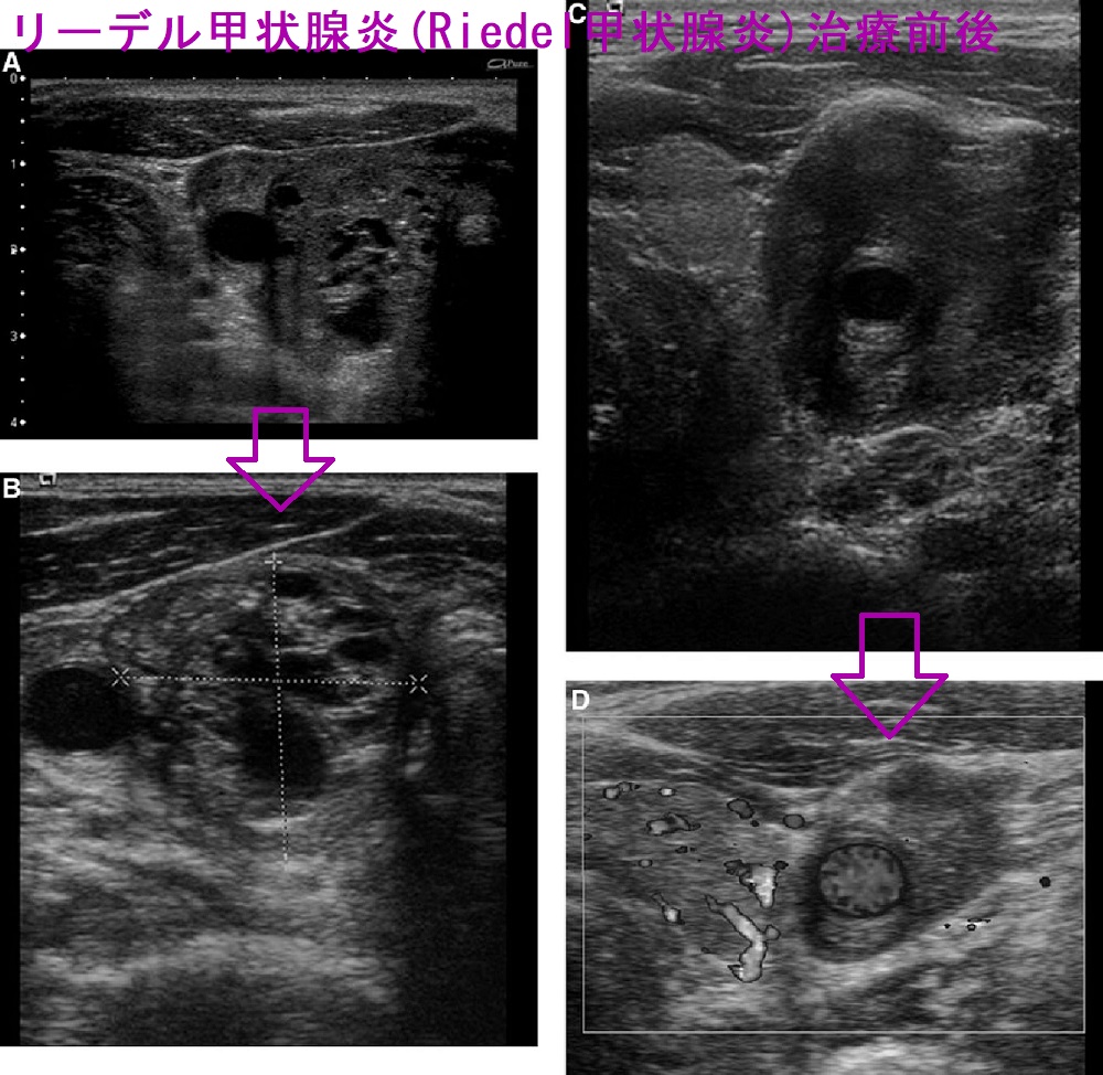 ステロイド治療前後のリーデル甲状腺炎(Riedel甲状腺炎)超音波(エコー)画像