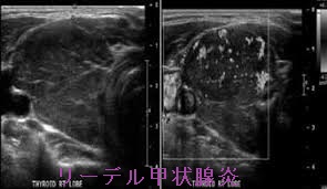 リーデル甲状腺炎(Riedel甲状腺炎)超音波(エコー)画像2