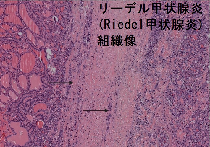 リーデル甲状腺炎(Riedel甲状腺炎)組織像