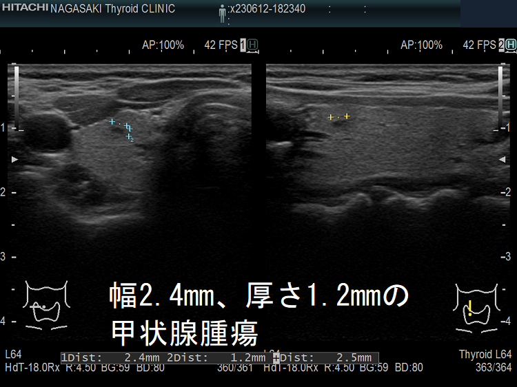 幅2.4mm、厚さ1.2mmの甲状腺腫瘍 超音波(エコー)画像