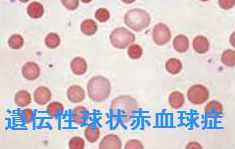 遺伝性球状赤血球症（溶血型）