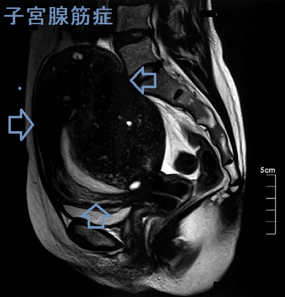 子宮腺筋症 骨盤部単純MRI T2 強調矢状断像