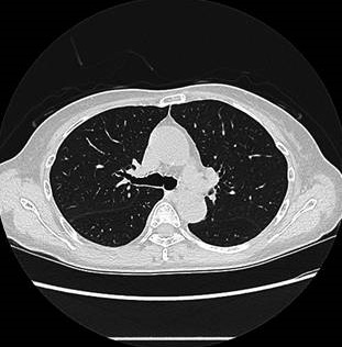 甲状腺がん転移検索CT 肺モード