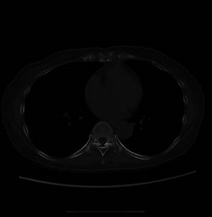 甲状腺がん転移検索CT 骨モード