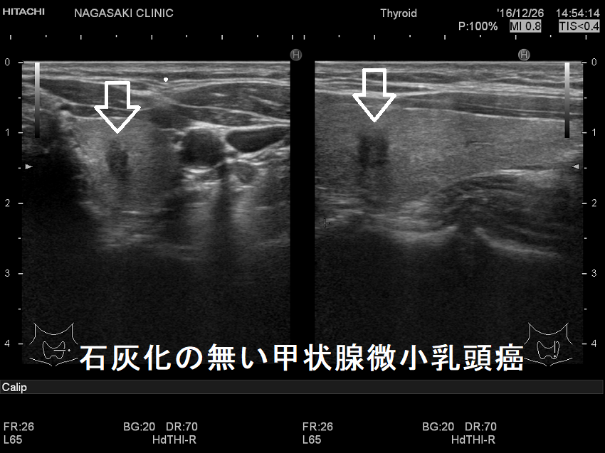 石灰化の無い甲状腺微小乳頭癌 超音波(エコー)画像