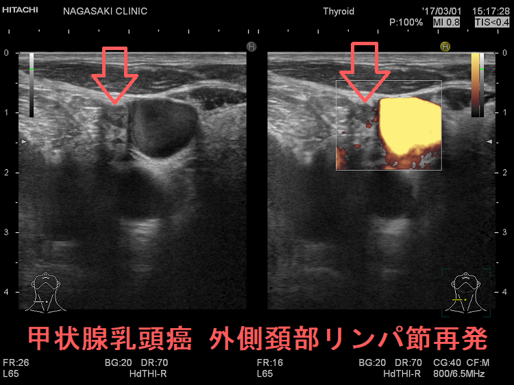 甲状腺乳頭癌 外側頚部リンパ節再発 超音波(エコー)画像